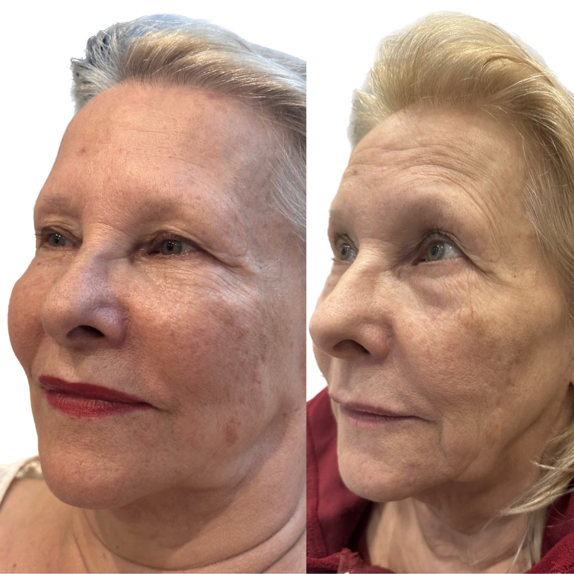 Before and after treatment results - Profile view