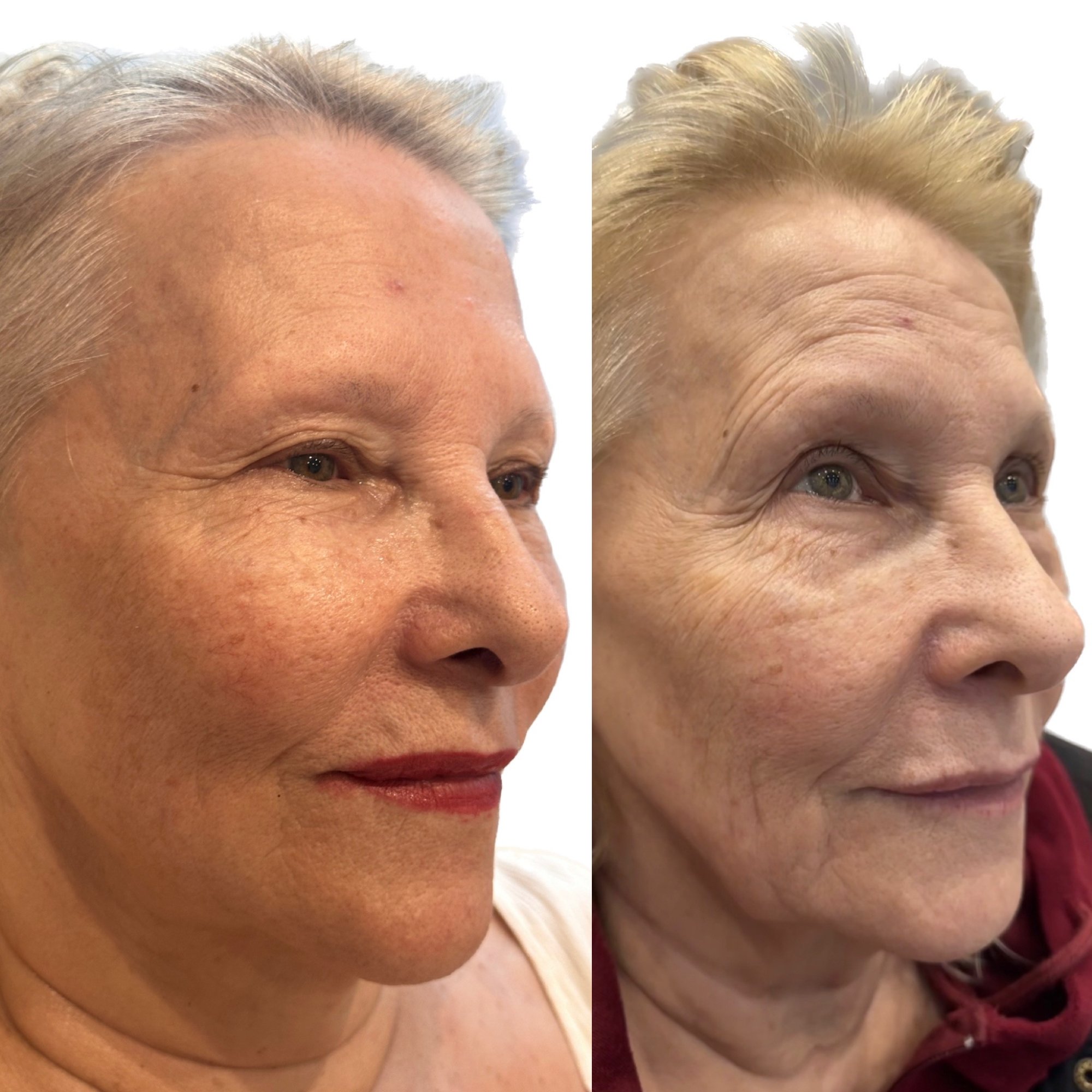 Before and after treatment results - Three-quarter view