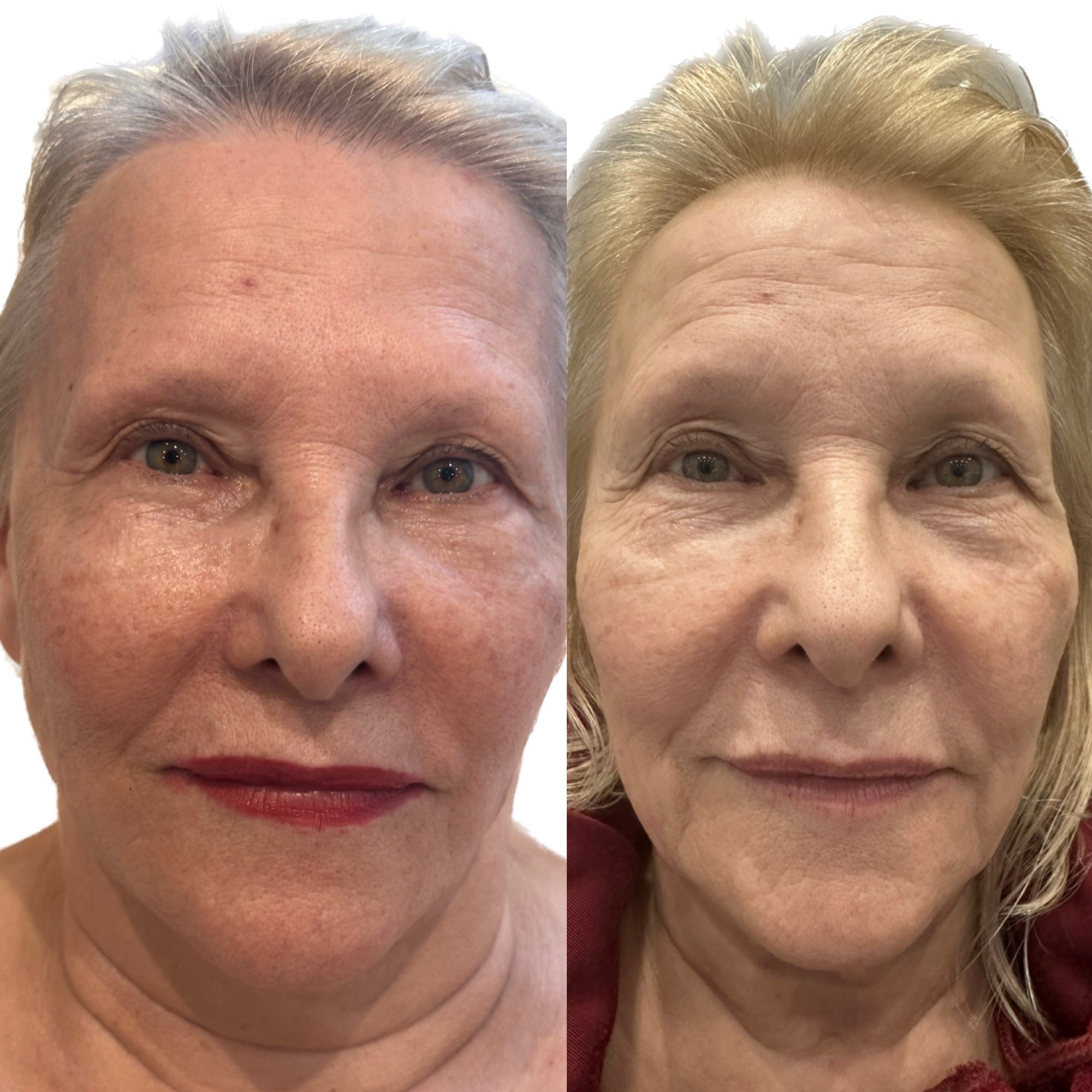 Before and after treatment results - Front view