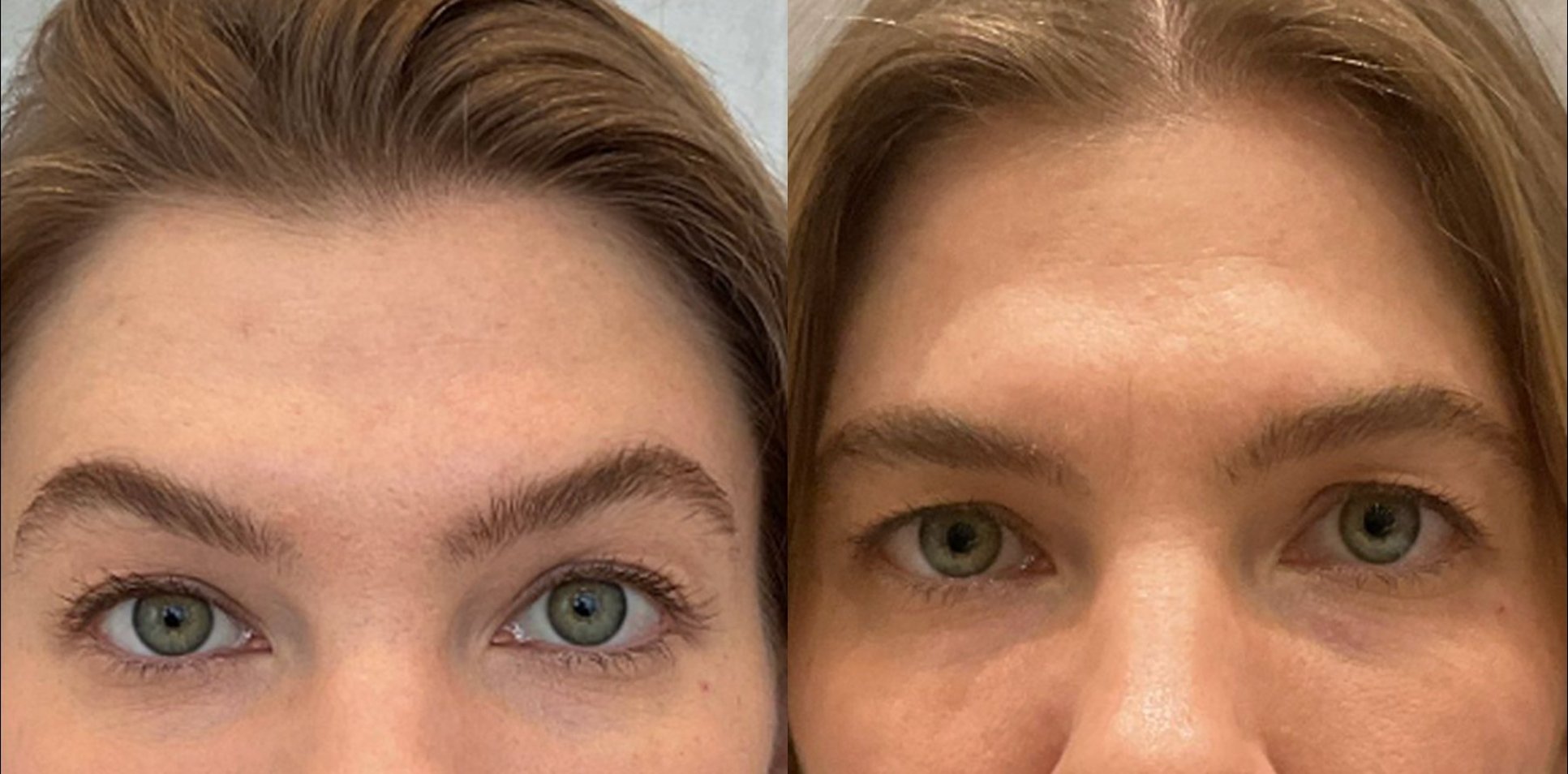 Before and after treatment results - Eye area front view