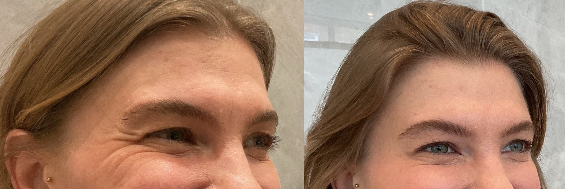 Before and after treatment results - Eye area side view